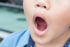 Orofacial myofunctional therapy for tongue tie in Monmouth County, NJ